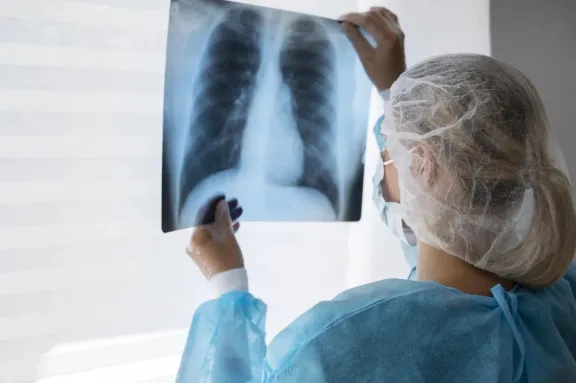 Preocupación en Entre Ríos: los casos de tuberculosis crecieron casi un 39% en lo que va de 2026